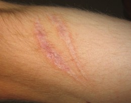 scars